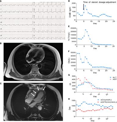 Case Report: Glucocorticoid Effect Observation in a Ureteral Urothelial Cancer Patient With ICI-Associated Myocarditis and Multiple Organ Injuries